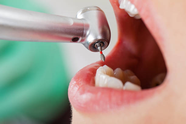 Best Emergency Dental Care for Broken or Chipped Teeth in Panora, IA